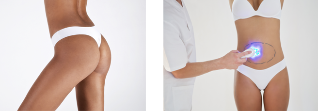 Benefits and Advantages of High Definition Liposuction