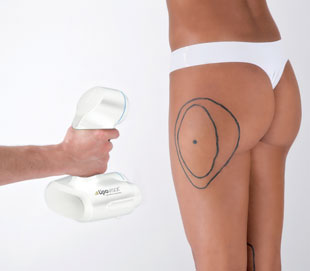 differences between traditional liposuction methods and liposuction with Lipovisor™