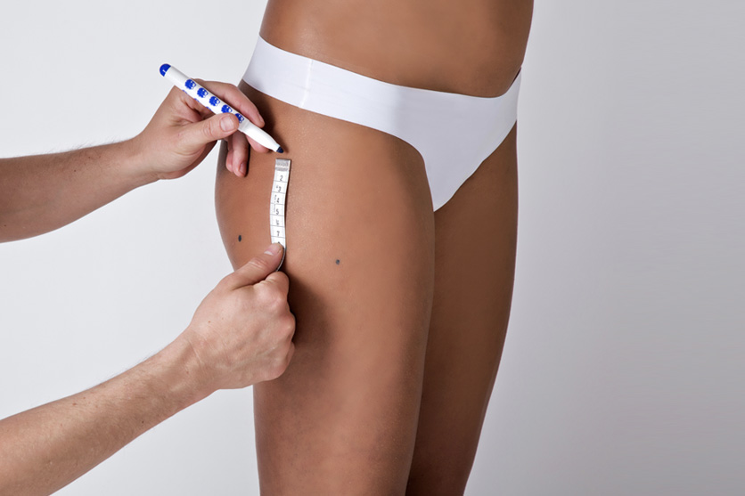 measuring the areas subject to aspiration during HD liposuction